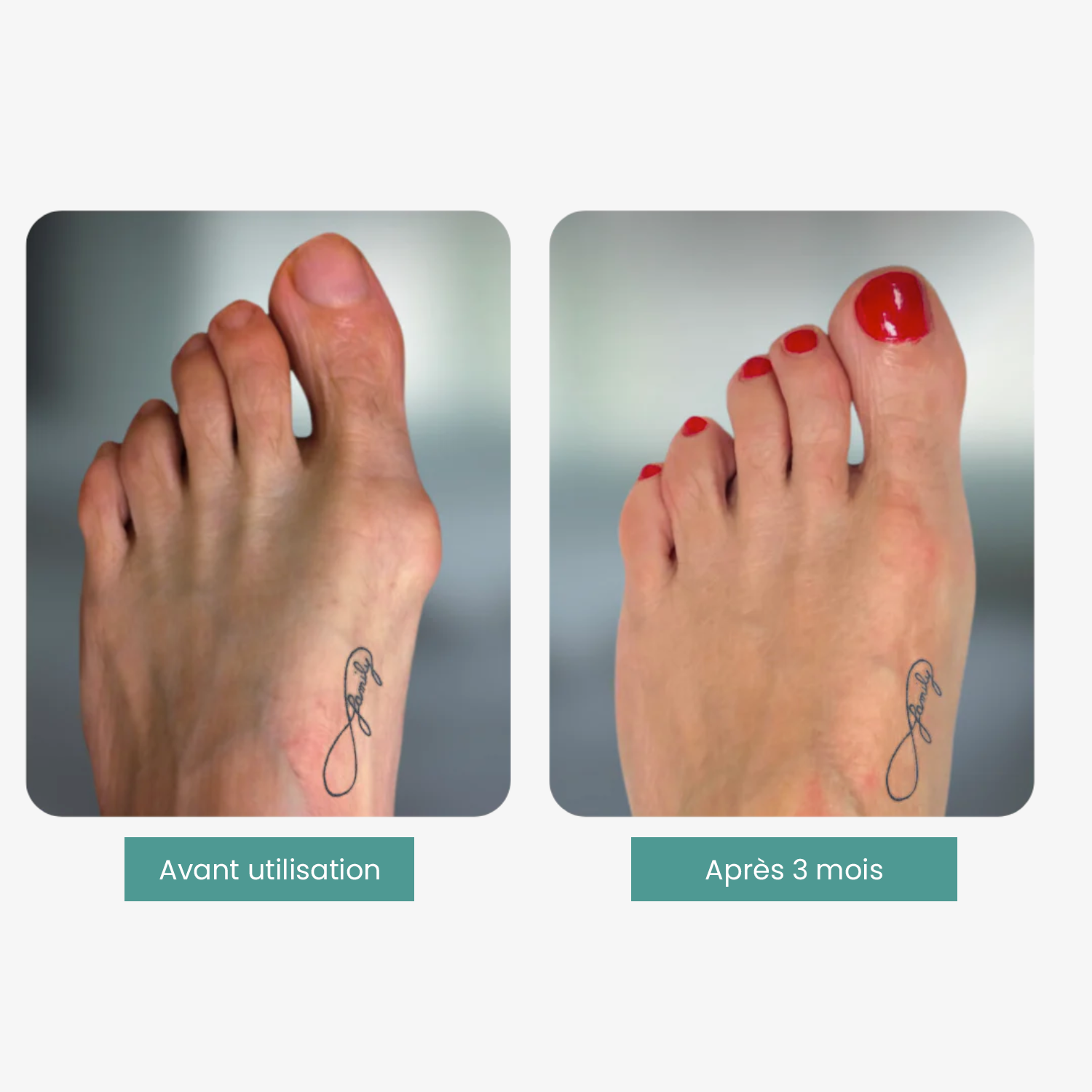 Correcteur universel Hallux Valgus