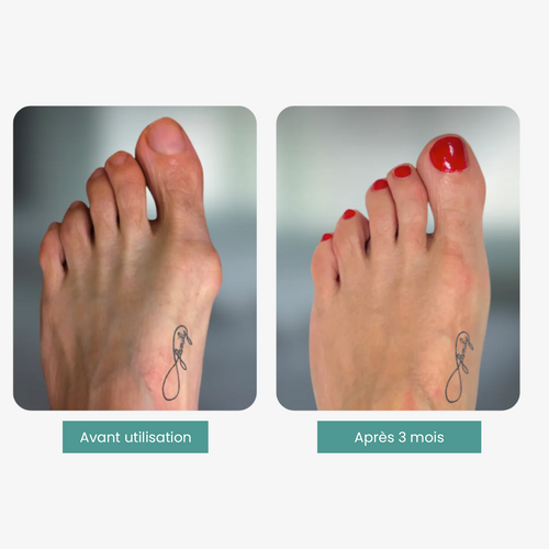 Correcteur universel Hallux Valgus