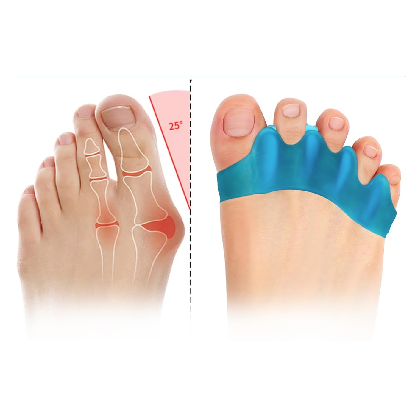 Séparateur d'orteils pour Hallux-Valgus et orteils en griffe